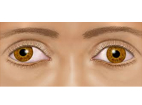 Lazy eye (“amblyopia”)