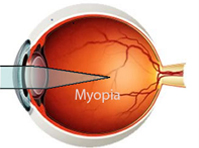 Myopia, hyperopia, astigmatism